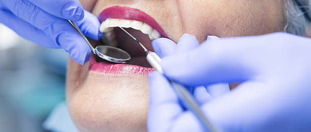 Best Emergency Tooth Extraction in French Mp, CA