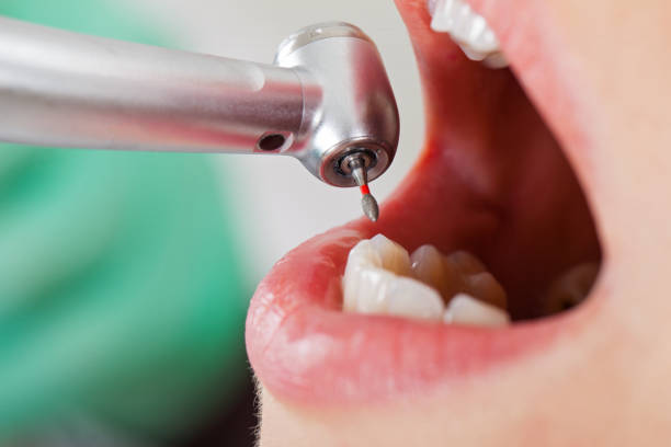 Best After-Hours Dental Trauma Care in French Mp, CA